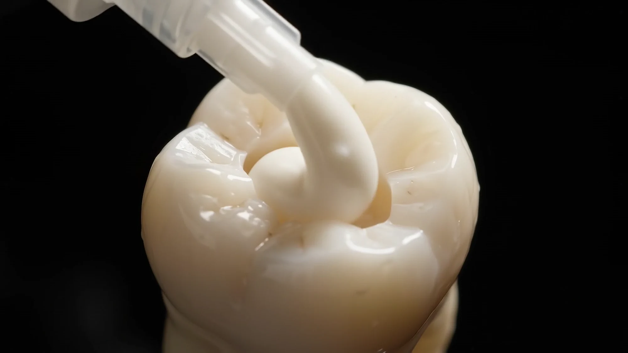 Composite being placed in a prepared tooth
